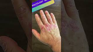 Dermatoses Resulting from Physical Factors Quiz  Part 2 medicalmcqs dermatologyquiz [upl. by Adorne]