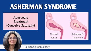 Asherman syndrome  cause symptoms amp ayurvedic treatment in Hindi endometrium ashermansyndrome [upl. by Devi]