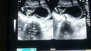 ultrasound fetal anomaly scankeyhole sign in posterior urethral valvesFetal ultrasound [upl. by Einahpats]