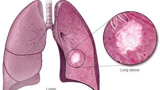 bronchogenic carcinoma [upl. by Fraser]