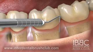 Periodontal disease causes and treatment [upl. by Anabelle]