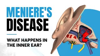 Menieres Disease  Inner Ear Impacts [upl. by Kieffer]