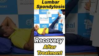 Lumbar Spondylosis Recovery After Treatment yt ytshorts ytshortsindia india kgf [upl. by Anelac610]