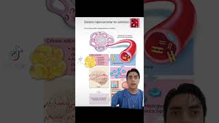 Diferencias de Cetoacidosis Diabetica CAD y Estado Heperosmolar Heperglucemico EHH [upl. by Ahsram]