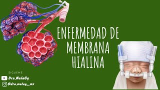 ENFERMEDAD DE MEMBRANA HIALINA [upl. by Ademla249]