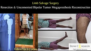 Treatment for Bone CancerChondrosarcomaFemurLimb Salvage SurgeryTumor Prosthesis DrSrimanth BS [upl. by Euqinahs36]