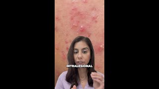 InOffice Cyst Treatment Shrink Acne in Just 24 Hours [upl. by Leal]