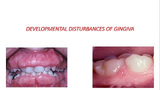 DEVELOPMENTAL DISTURBANCES OF GINGIVA [upl. by Aleacem]