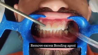 Orthodontic Bonding Procedure [upl. by The]