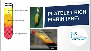 PLATELET RICH FIBRIN PRF IN PERIODONTICS BIOLOGIC PROPERTIES PREPARATION PRF MEMBRANE PRF PLUG [upl. by Atinrehs]