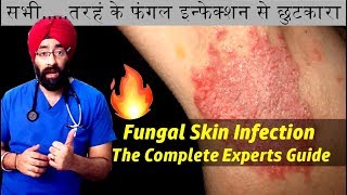 Permanently Cure FUNGAL SKIN INFECTIONS  दाद फंगस के कारन और इलाज  हिंदी मे  by DrEducation [upl. by Juanne]