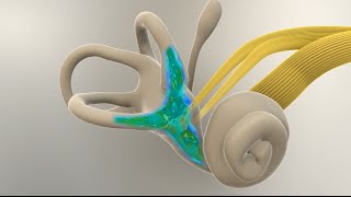 Menieres Disease  What Happens in the Inner Ear [upl. by Erodoeht]