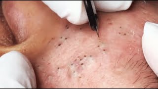 ENJOY YOUR DAY WITH GA SPA PART III relaxing blackheads [upl. by Fritz925]