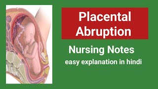 Placental abruption Abruptio placentae nursing Noteseasy explanation in hindi [upl. by Badr736]