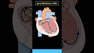 What is Atrial Fibrillation AF or AFib atrialfibrillation cardiology arrhythmia heart [upl. by Reemas]