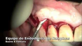 Descolamento de Retalho na Cirurgia ParaendodÃ´ntica  Equipe de Endodontia de Campinas [upl. by Ybeloc]