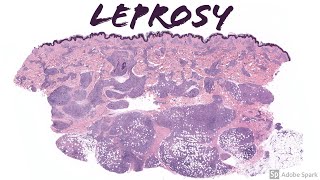 Lepromatous Leprosy Hansen Disease 5Minute Pathology Pearls [upl. by Gorden]