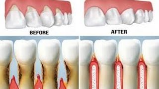 How To Reverse Receding Gum line Without Surgery [upl. by Sardse486]