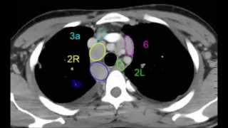 Les ganglions médiastinaux en scanner pour les internes [upl. by Durwin]