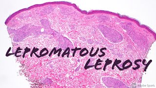 Lepromatous Leprosy 5Minute Pathology Pearls Dermatology Dermatopathology [upl. by Enidualc]