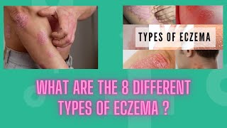 What Are the 8 Different Types of Eczema eczema [upl. by Aenej]