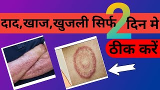 Best Eczema treatment  दादखाजखुजली कैसे ठीक करें eczema [upl. by Chivers]