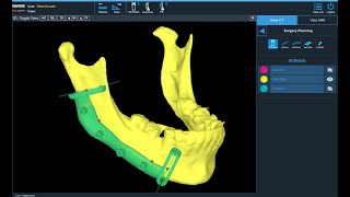 AIbased segmentation 3D modelling and Cutting Guides for Maxillofacial Surgical Applications [upl. by Alioz]