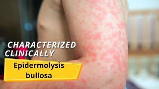 Epidermolysis bullosa  Symptoms and causes [upl. by Llenrrad40]