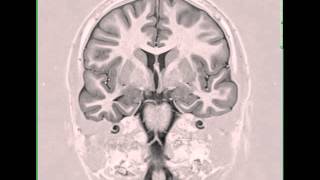 Mesial Temporal Sclerosis Right [upl. by Irep]