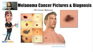 Spotting Melanoma Cancer and Symptoms with Pictures [upl. by Mcclish]