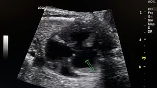 fetal ultrasound shows tricuspid atresia [upl. by Vastah]