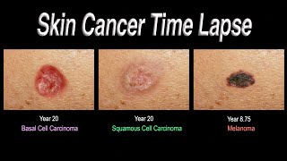 Skin Cancer Time Lapse Basal Cell Carcinoma Squamous Cell Carcinoma Melanoma [upl. by Nhguavad]