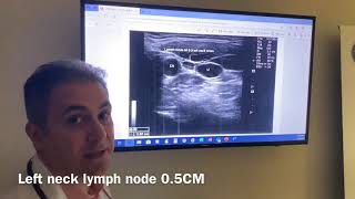 Sean Nikravan MD Thyroid Cancer and Lymph nodes neck surveillance follow up [upl. by Millur101]