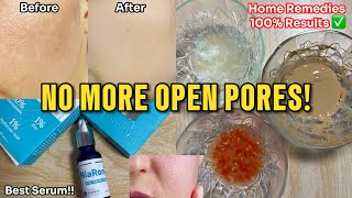 How to get Rid of Large Open Pores Best Home Remedies  Abial openpores [upl. by Egrog100]