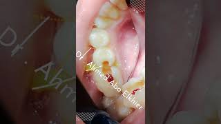 Single Visit Endodontic Treatment الكربولة endodontics dental [upl. by Clausen]