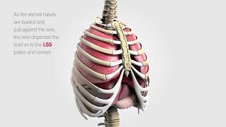 Longitudinal Sternal Stabilization LSS [upl. by Alden199]