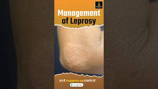 Management of Leprosy  Treatment Prevention Leprosy management treatment shortvideo nursing [upl. by Airyk]