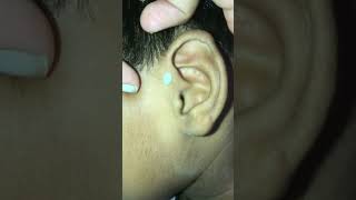 Squeezing preauricular pit earpit satisfying pimplepopping [upl. by Okin]