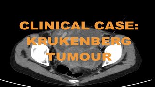 Clinical case  Metastatic cholangiocarcinoma cancer on CT abdomen  How to read and diagnose [upl. by Chadd703]