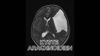 KYSYE ARACHNOIDIEN science femmemedecine radiologystudent info [upl. by Aivatal]