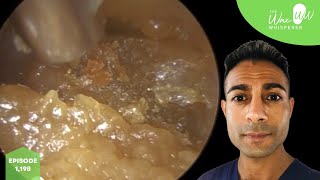 1198  Blocked Ear Wax Removal with Benign Osteoma [upl. by Brandise56]