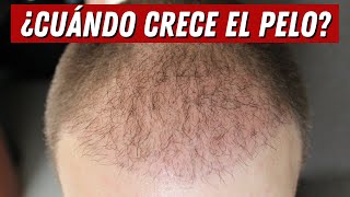 45 Meses de MI TRASPLANTE CAPILAR Y NO TENGO PELO [upl. by Azer]