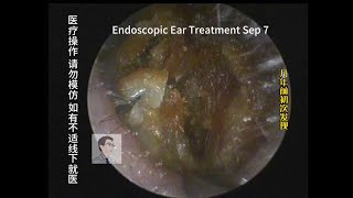 Regular followup of cholesteatoma 20230907 [upl. by Coridon933]