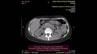 TOMOGRAFIA SIMPLE DE ABDOMEN [upl. by Oiretule523]