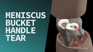 Meniscus Bucket Handle Tear [upl. by Eimoan851]