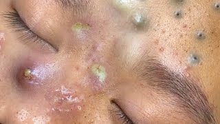 Big Cystic Acne Blackheads Extraction Blackheads amp Milia Whiteheads Removal Pimple Popping  8378 [upl. by Swithin340]