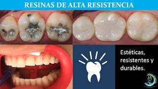 Resinas dentales de alta resistencia [upl. by Eniliuqcaj807]