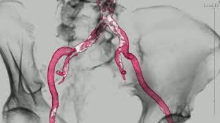 Severe aortoiliac calcification [upl. by Accalia]