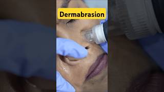 Dermabrasion facial glowingskin [upl. by Noevad171]