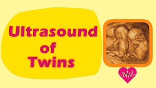 Sonography of Twins [upl. by Lohse]